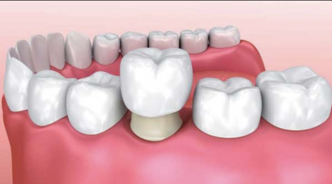 Rehabilitación Oral