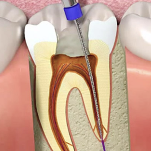 Endodoncia