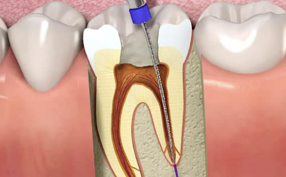 Endodoncia