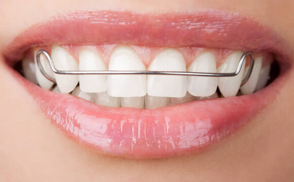 Importancia del uso de retenedores tras la ortodoncia.